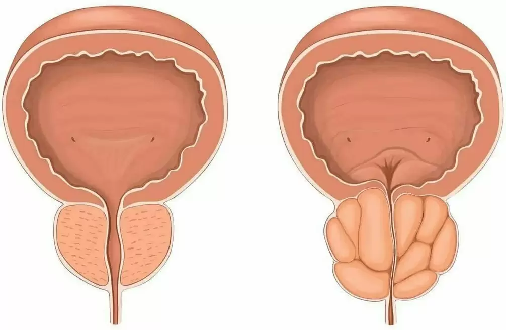 Zdravá prostata a prostatitida