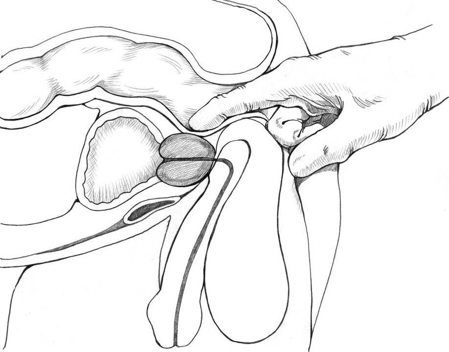 Masáž prostaty je součástí komplexu léčebných metod prostatitidy