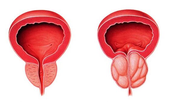 Normální a zanícená prostata (prostatitida)