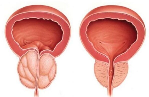 normální a zvětšená prostata s prostatitidou
