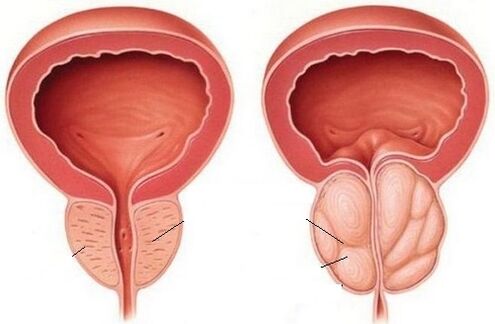 zdravá a zanícená prostata s chronickou prostatitidou